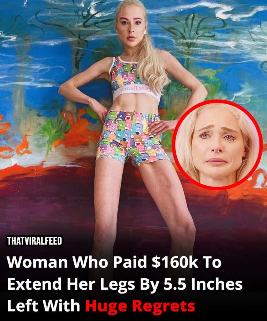 Woman Who Paid $165,000 To Extend Her Legs By 5.5 Inches Left With Huge Regrets After Surgery