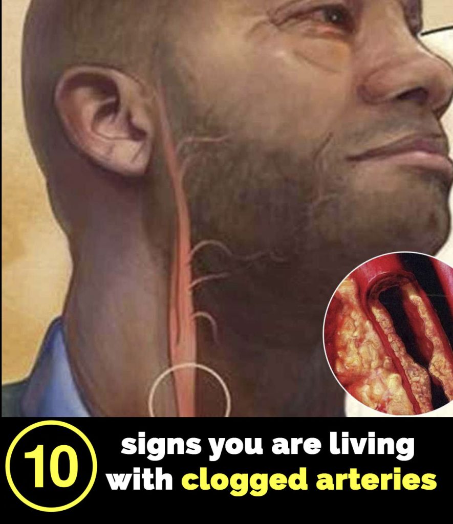 10 signs your arteries might be clogged