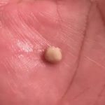 Here’s what you need to know about tonsil stones