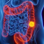 Woman with stage four colon cancer reveals five symptoms she initially dismissed