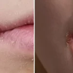 Warning issued to anyone who thinks they have ‘chapped lips’ as the weather turns colder